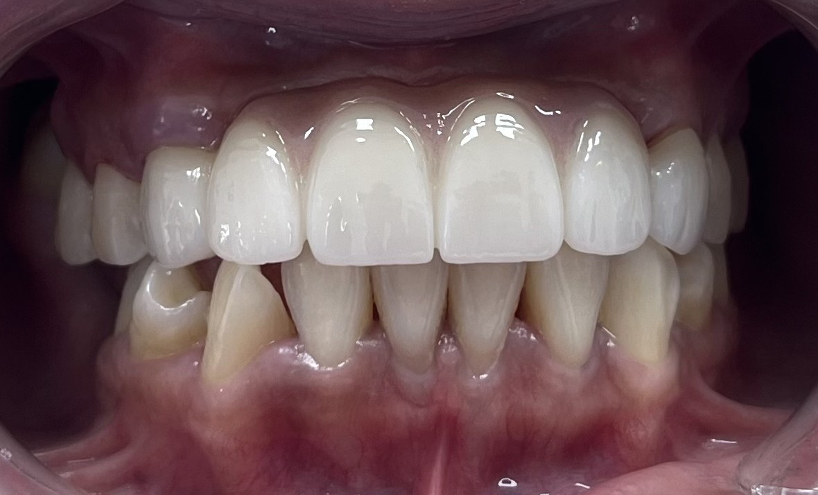 Patient smile result